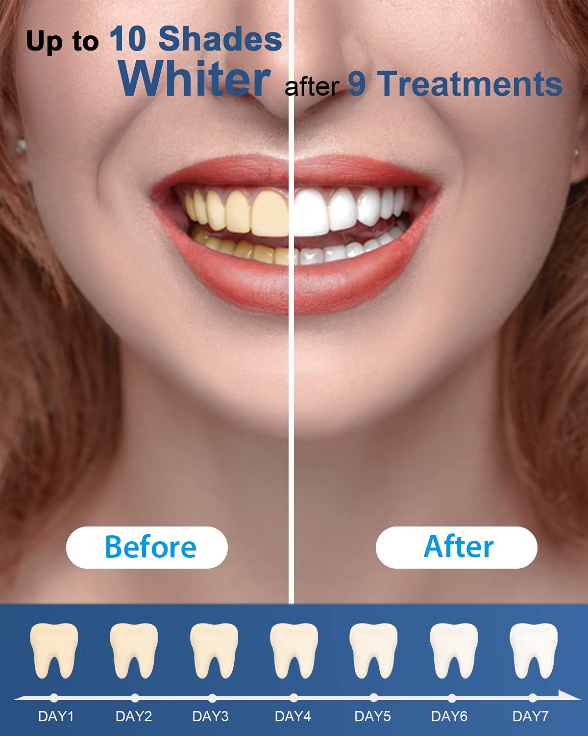 MySmile Teeth Whitening Gel Refills Pack 30+ Treatment Non-Sensitive Enamel Safe Tooth Whitener -10 Min Fast Whitening Teeth - Helps to Remove Stains from Coffee, Smoking, Wines(Excluding Tray Light) 🍁 All In One Marketplace Canada