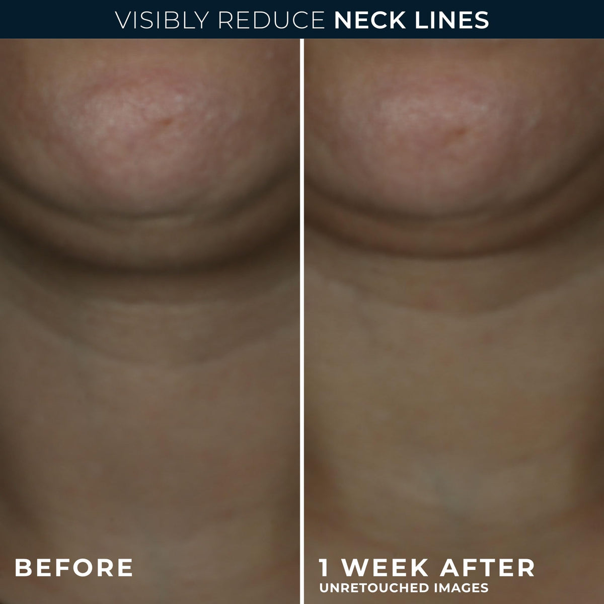 RoC Derm Correxion® Neck Cream with Hyaluronic Acid and Advanced Retinol to visibly Tighten & Lift Horizontal Neck Lines, Facial Moisturiser to Contour Face, Neck and Jawline, 50ML 🍁 All In One Marketplace Canada