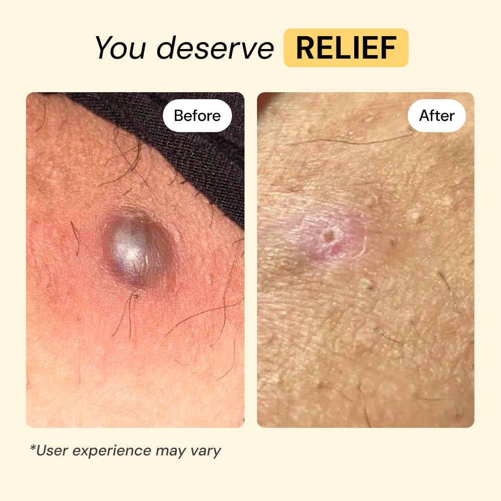 MyMagicHealer Universal Flare Care – Multi-Purpose Solution | Skin Flare-Ups - Hidradenitis Suppurativa, Folliculitis, Boils, Cysts | Anti-Chafing | Irritated Skin Relief w/Propolis & Egg Yolk 28 g 🍁 All In One Marketplace Canada