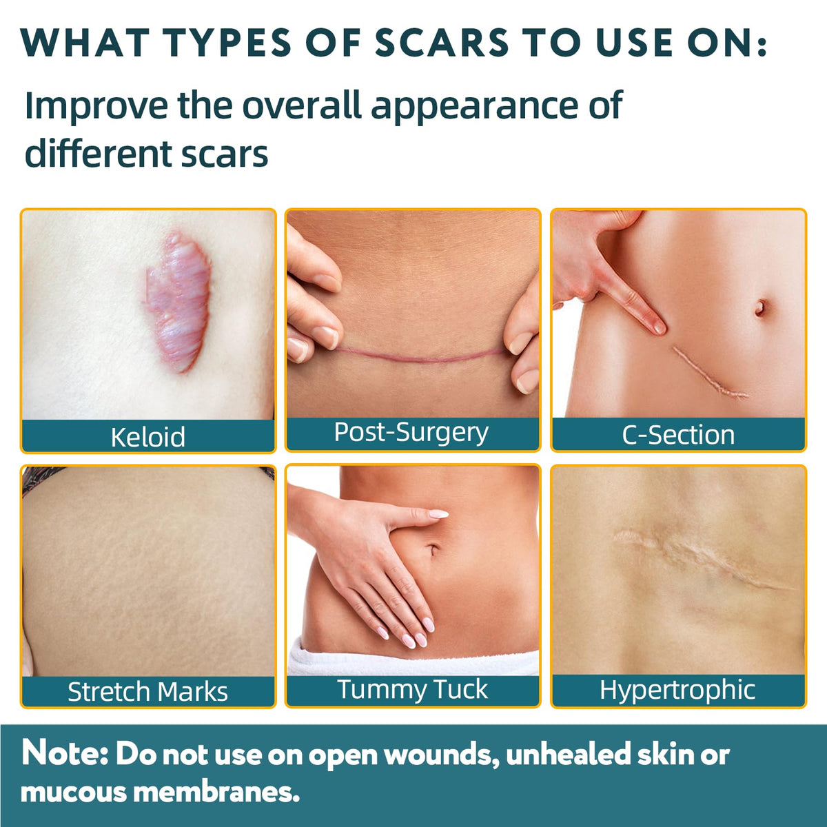 Silicone Scar Sheets, Silicone Scar Tape for Surgical Scars - 60" x 1.6" Roll - 1.5M, Medical Grade Reusable Scar Removal for Keloid, C-Section, and Tummy Tuck 🍁 All In One Marketplace Canada