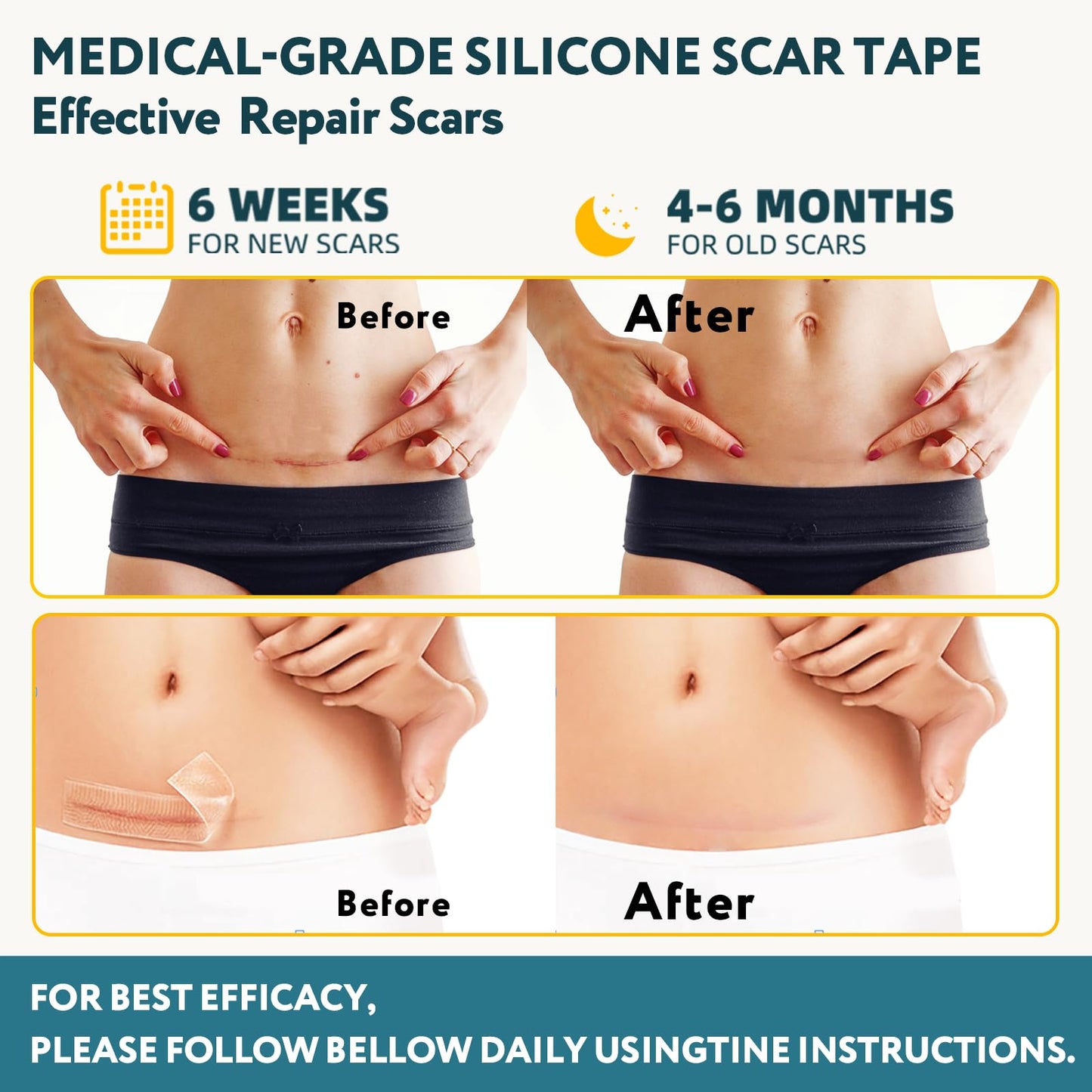 Silicone Scar Sheets, Silicone Scar Tape for Surgical Scars - 60" x 1.6" Roll - 1.5M, Medical Grade Reusable Scar Removal for Keloid, C-Section, and Tummy Tuck 🍁 All In One Marketplace Canada