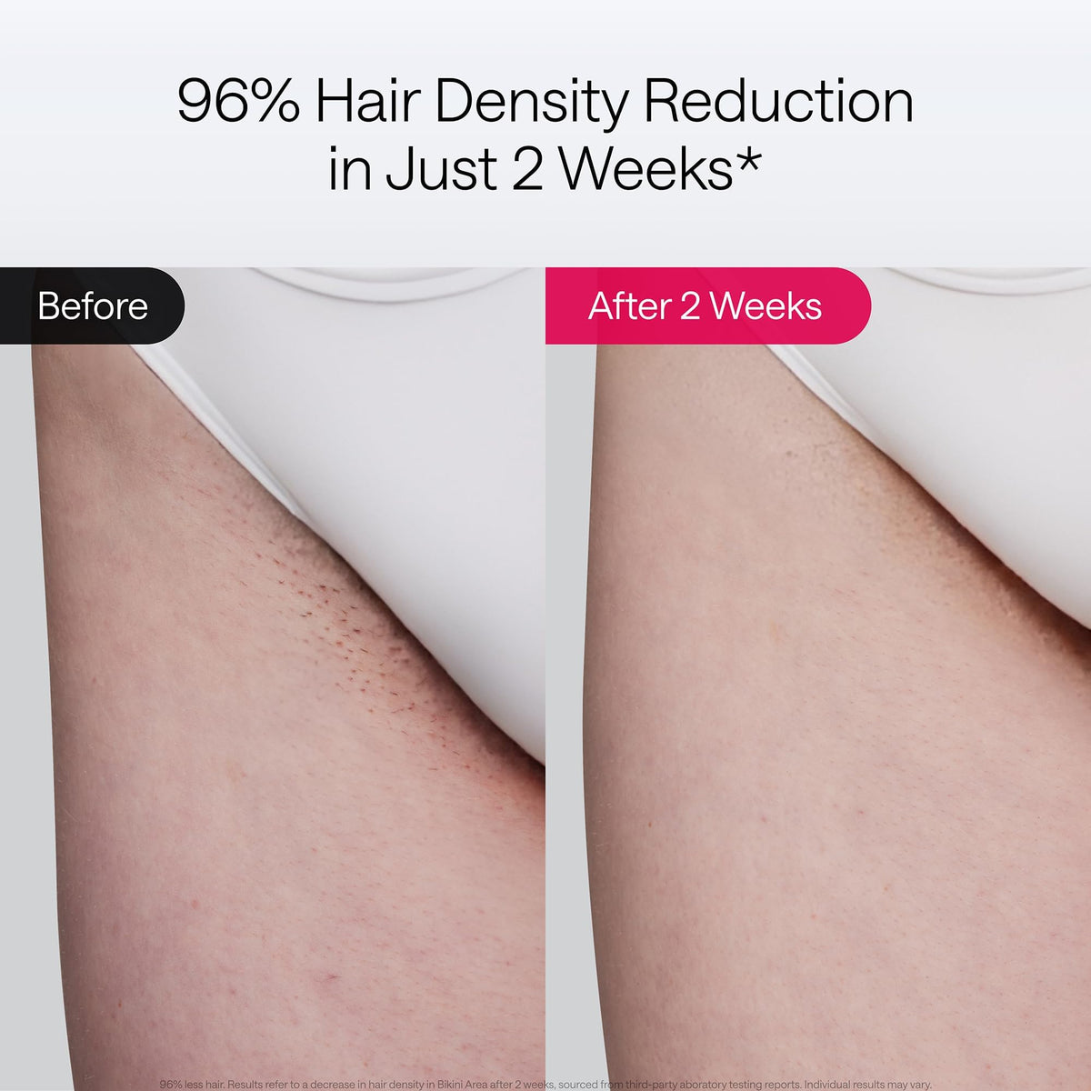 Ulike Laser Hair Removal, Air 10 IPL Device for Women and Men, 65°F Ice-Cooling Contact, Dual Lights, Skin Sensor & SHR Mode* for Nearly Painless, Effective & Long-Lasting Results from Home 🍁 All In One Marketplace Canada