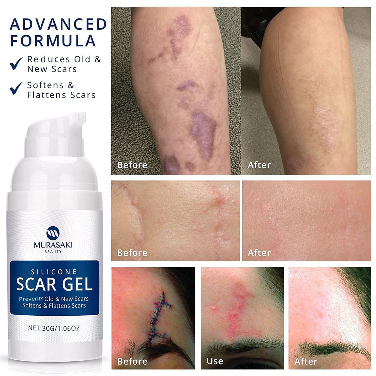 100% Silicone Scar Gel Scar Cream - Advanced Scar Gel for Old and New Scars 🍁 All In One Marketplace Canada
