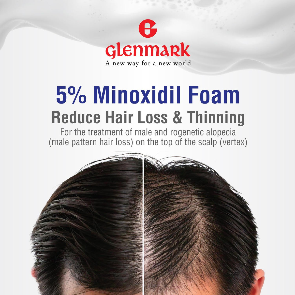 Glenmark | Minoxidil 5% Hair Regrowth Foam for Men, Aerosol Can, 3 Month Treatment (180 gr) – Mess-Free, Fast-Drying Formula for Thinning Hair & Hair Loss – Reactivates Follicles 🍁 All In One Marketplace Canada
