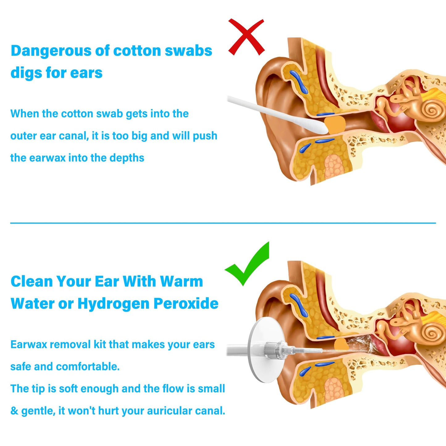 TopQuaFocus 500ml Earwax Remover Ear Cleaner Irrigation Tool Ear wax Removal Flushing System Earwax Cleaning Spray Bottles Ear Flush System for Adults & Kids (16.9oz) 🍁 All In One Marketplace Canada