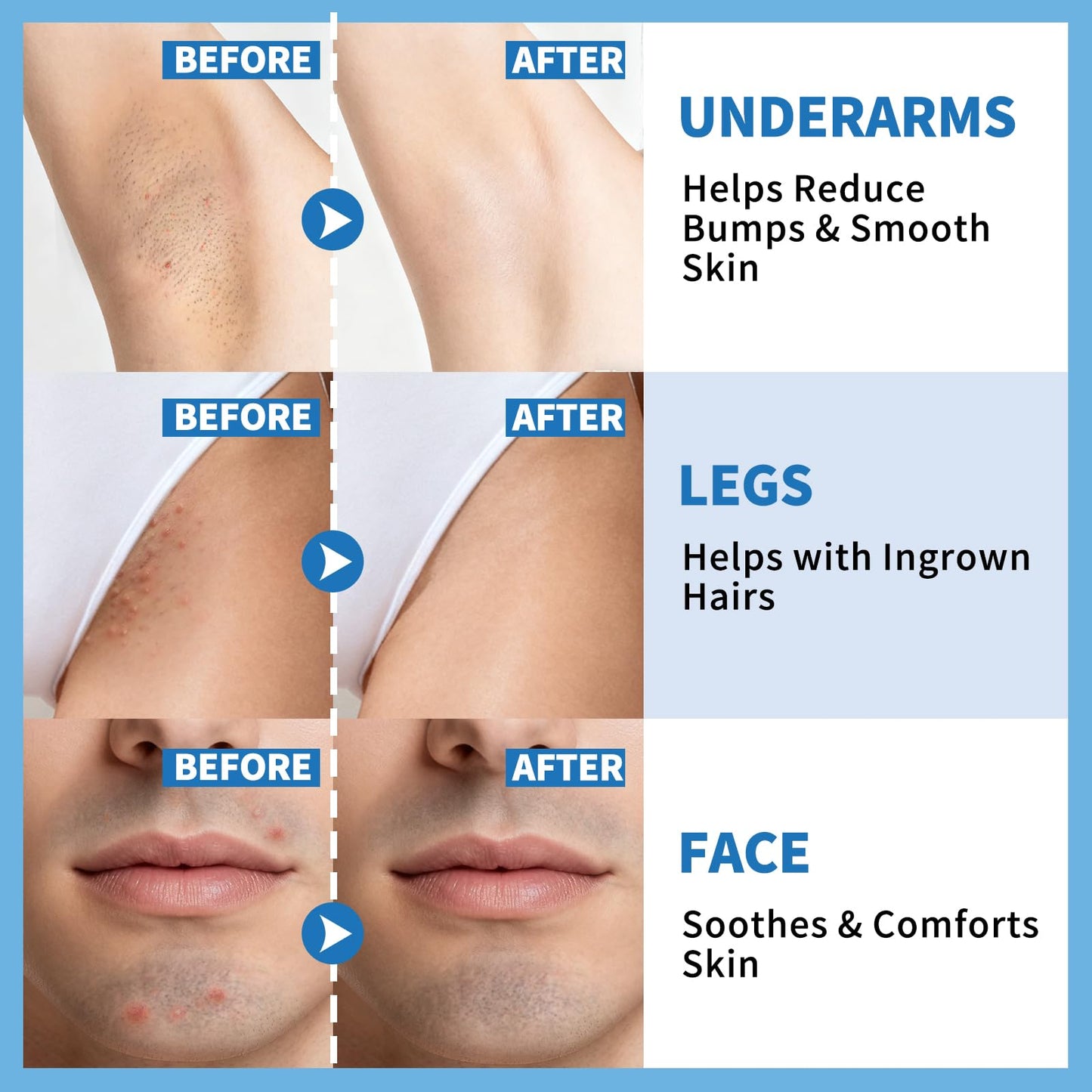 dewyhour Ingrown Hair & After Shave Soothing Serum – Soothes Razor Irritation, Targets Dark Spots, Helps With Razor Bumps for Face, Underarms, Neck & Bikini Area. Korean Skincare Roll-On for Men & Women 🍁 All In One Marketplace Canada