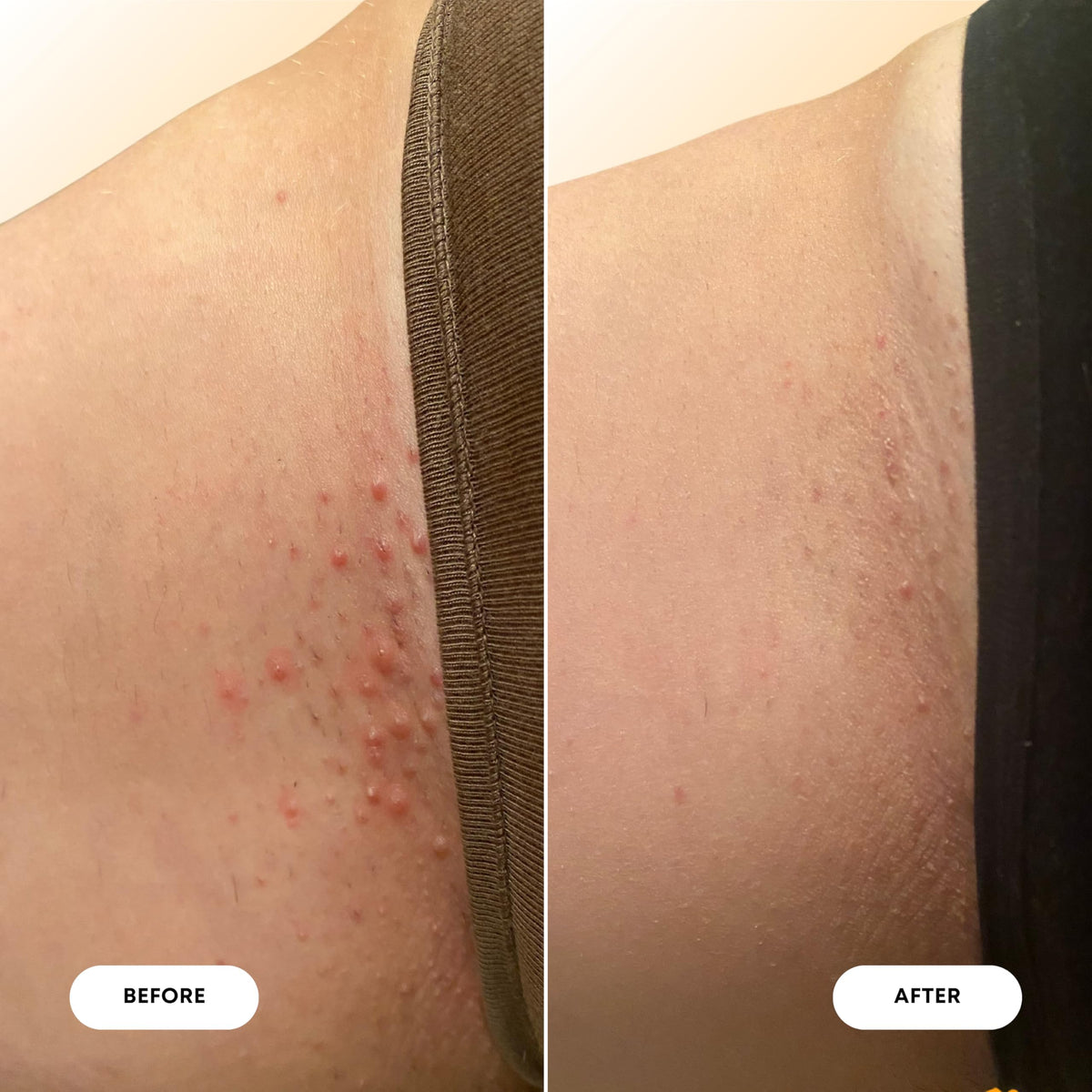 Bushbalm Ingrown Hair Oil - Helps Reduce, Repair Skin from Ingrown Hairs, Razor Bumps & Underarm Bumps - Soothe Skin from Post Shave Itchiness 30 ml - Vanilla Tangerine Oil - Formerly Sweet Escape 🍁 All In One Marketplace Canada