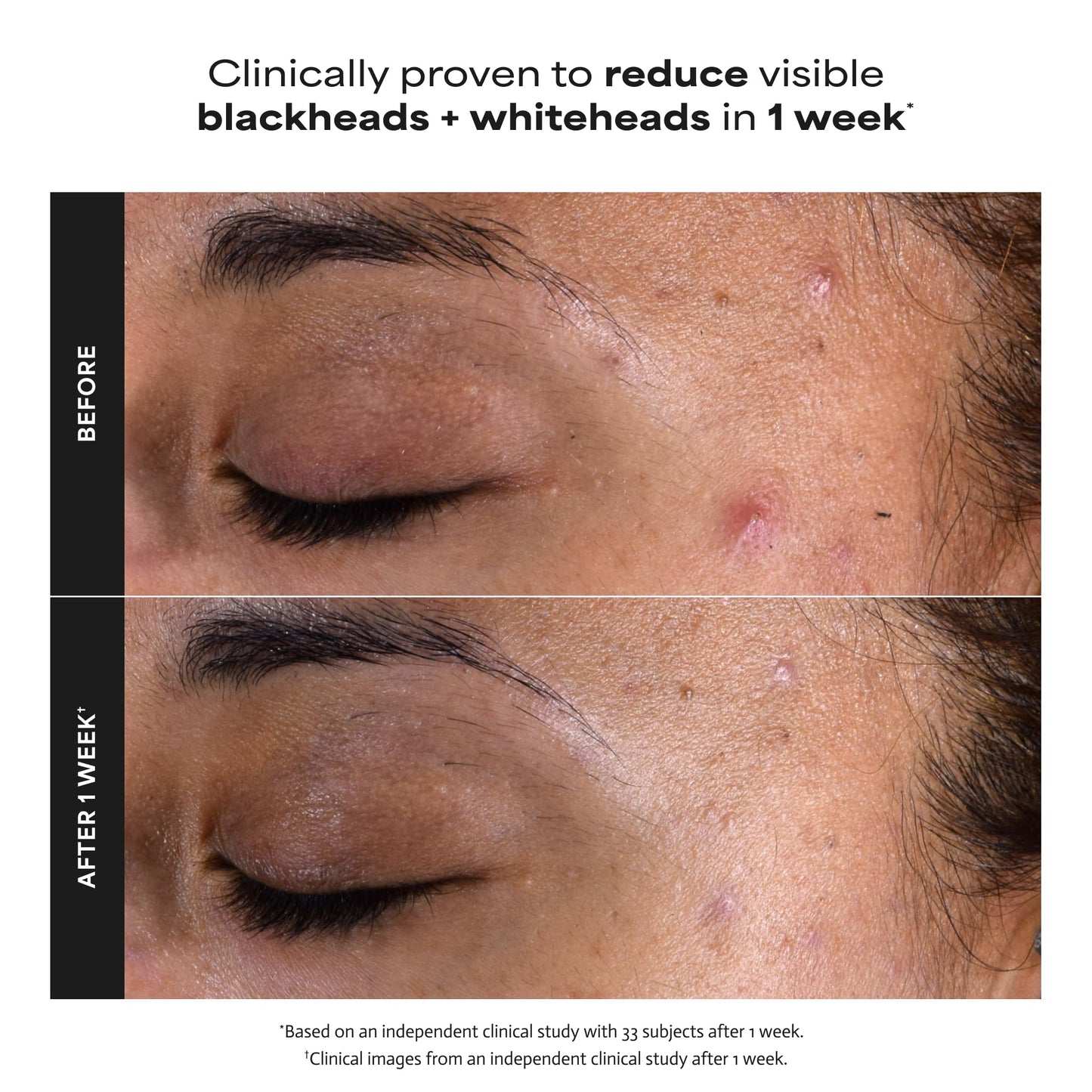 Paula's Choice SKIN PERFECTING 2% BHA Liquid Salicylic Acid Exfoliant, Daily Facial Exfoliator for Enlarged Pores, Wrinkles & Fine Lines, Fragrance-Free, Travel Size - 30 ml 🍁 All In One Marketplace Canada