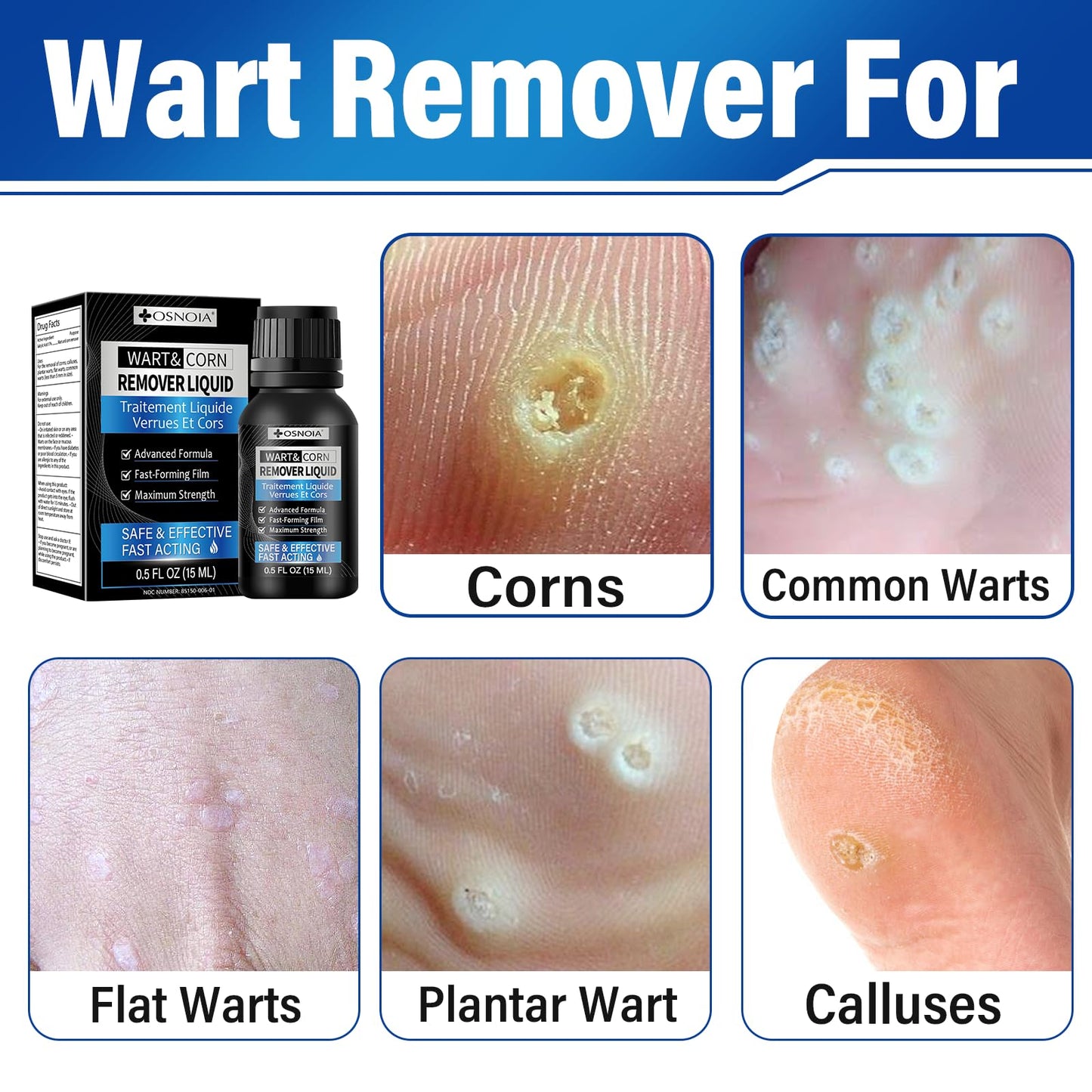 OSNOIA Extra Strength Wart Remover Liquid with 17% Salicylic Acid, Fast Acting Treatment for Plantar & Common Warts, Corn Remover for Feet and Toes (15ml, Wart Remover Set) 🍁 All In One Marketplace Canada